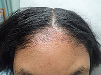 Irritant contact dermatitis from hair relaxer